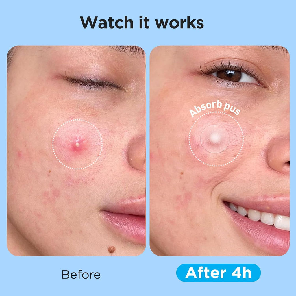 Pimple Patches for Face (504 Count), FSA Eligible Acne Patch Bulk, Zit Stickers 4 Sizes, Hydrocolloid Spot Stickers, Clear Acne Dots for Covering Zits, Blemishes and Breakouts