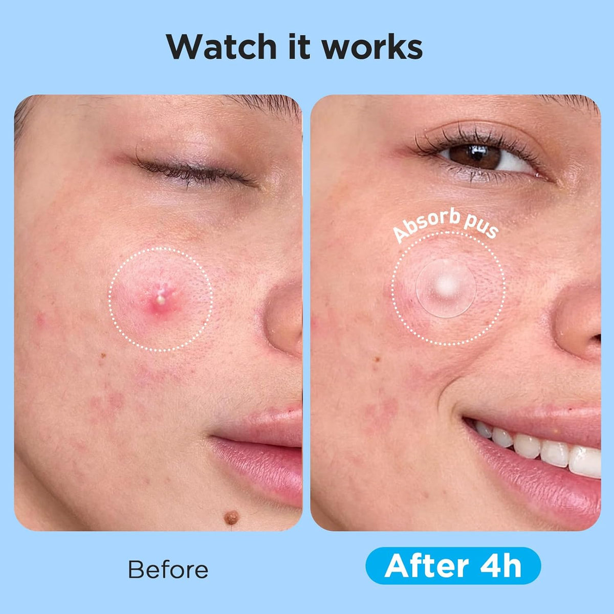 Pimple Patches for Face (504 Count), FSA Eligible Acne Patch Bulk, Zit Stickers 4 Sizes, Hydrocolloid Spot Stickers, Clear Acne Dots for Covering Zits, Blemishes and Breakouts