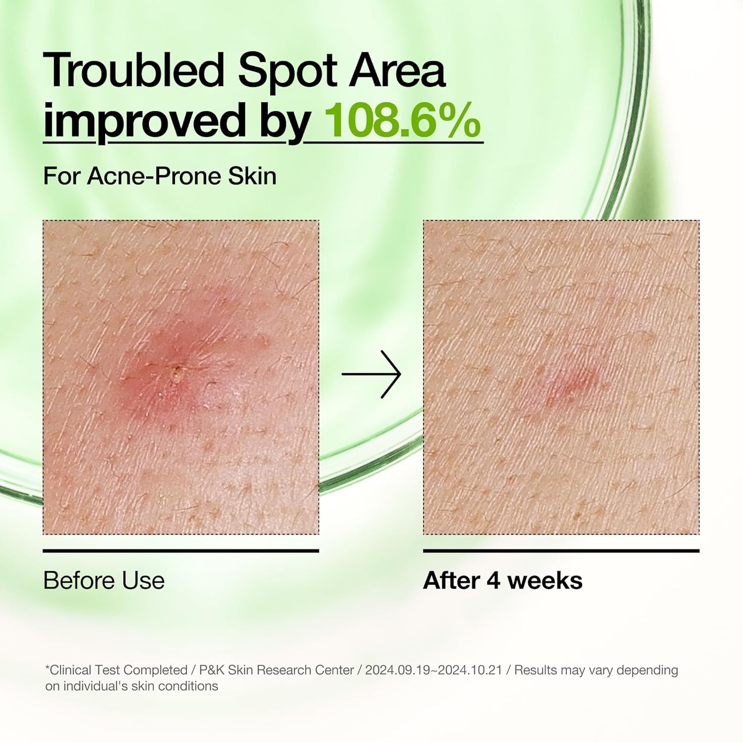 Anua Azelaic Acid 10 Hyaluron Redness Soothing Serum, Facial Serum for Blemish-Prone & Oily-Prone Skin, Lightweight & Hydrating Blemish Care, Hyaluronic Acid, Korean Skincare, 1.01 fl oz.